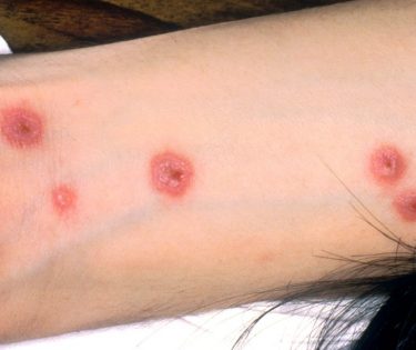 sindromul Stevens-Johnson